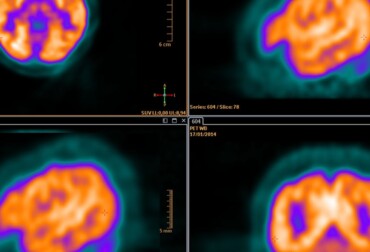 if pet scan is positive can it be anything but cancer
