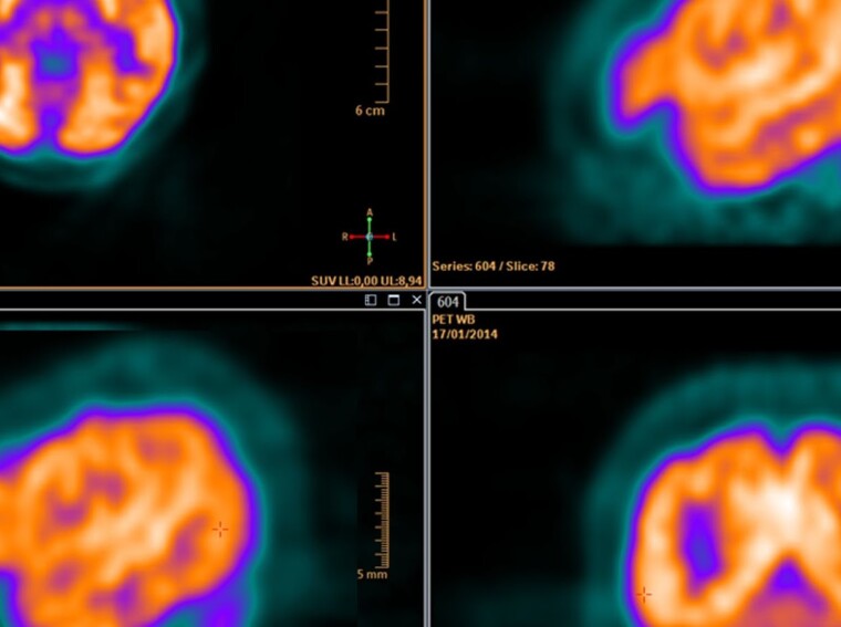 if pet scan is positive can it be anything but cancer